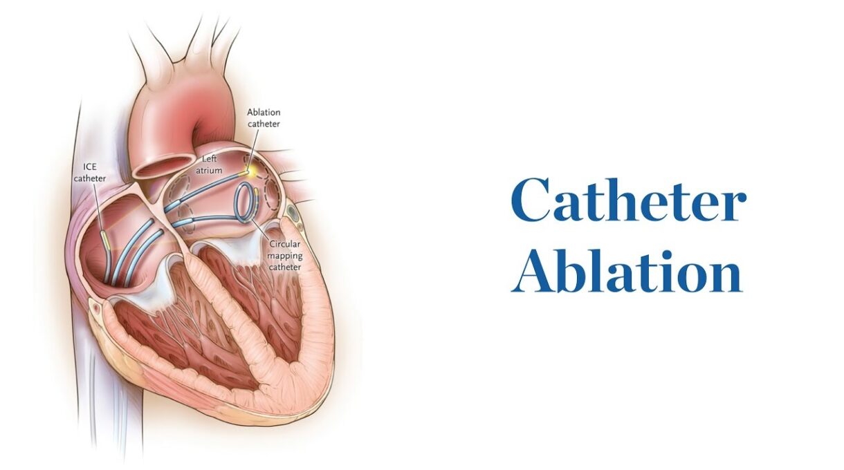 Catheter Ablation