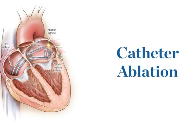 Smooth Recovery: Tackling Challenges in the Aftermath of Catheter Ablation