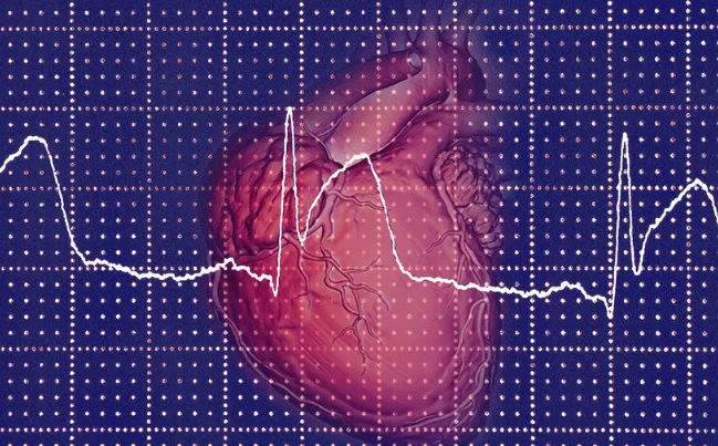 Myocardial Infarction ICD 10