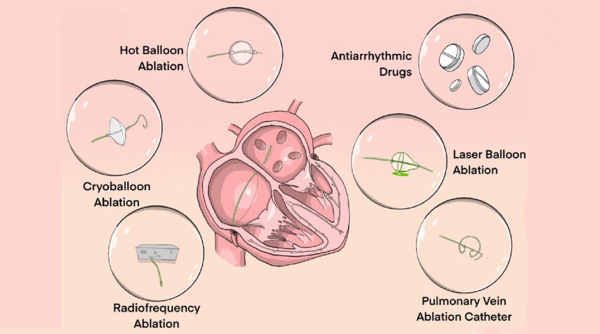 Paroxysmal Atrial Fibrillation