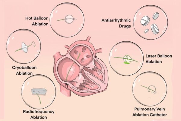 Unveiling the Comprehensive Guide to ICD-10 Paroxysmal Atrial Fibrillation