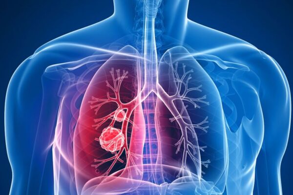 As we diverge from smoke’s grip, the genetic tapestry of lung cancer unfurls, revealing a path illuminated by molecular intricacies