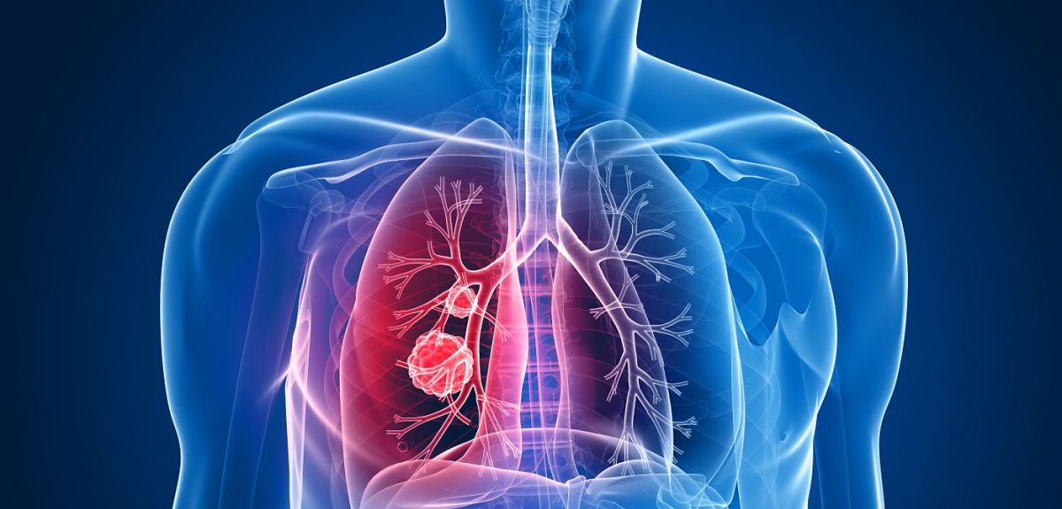 lung cancer unfurls